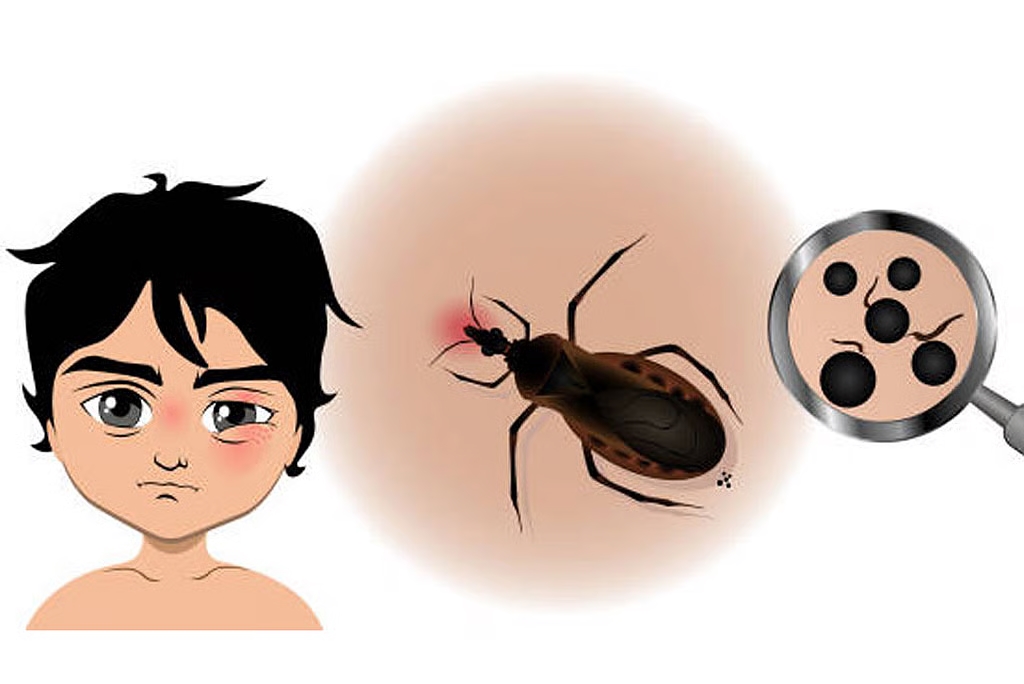 chagas disease