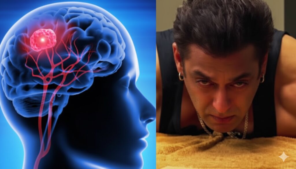 ब्रेन एन्यूरिज्म