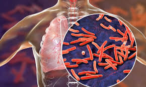 India's major victory against TB, number of patients reduced by 21% in 9 years. NewG India